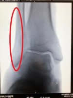 Fibula break.jpg